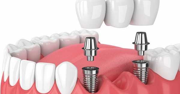 12 най-добри клиники за зъбна имплантация в Москва